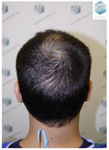 injerto pelo en españa