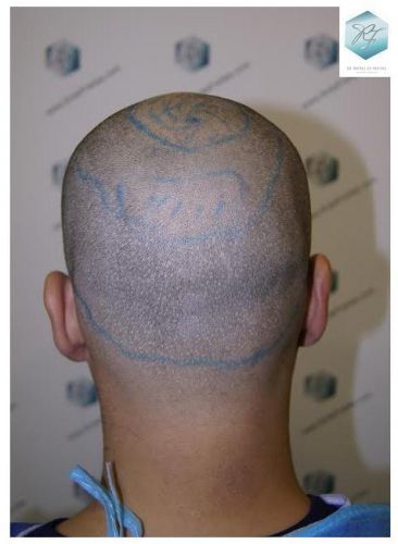 injerto pelo en españa