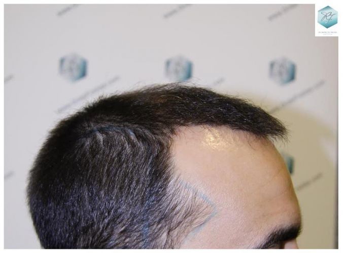 injerto pelo en españa