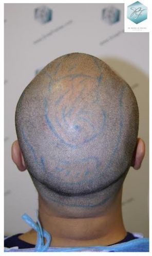 injerto pelo en españa
