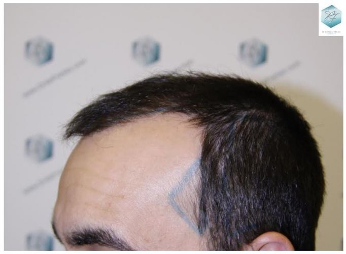 injerto pelo en españa