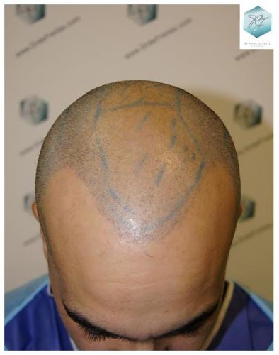 injerto pelo en españa