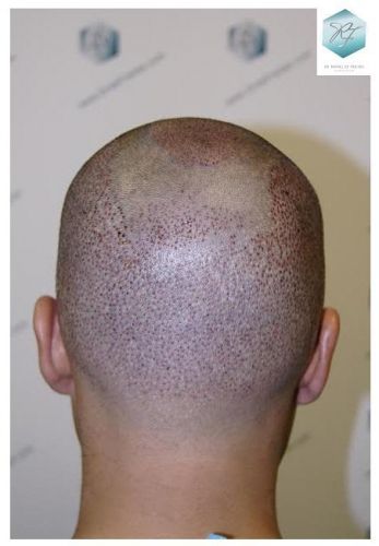 injerto pelo en españa