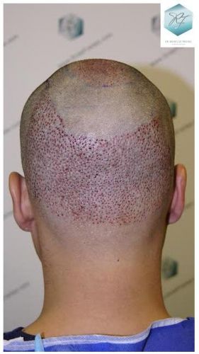 injerto pelo en españa