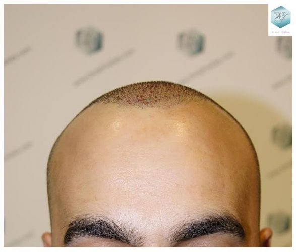 injerto pelo en españa