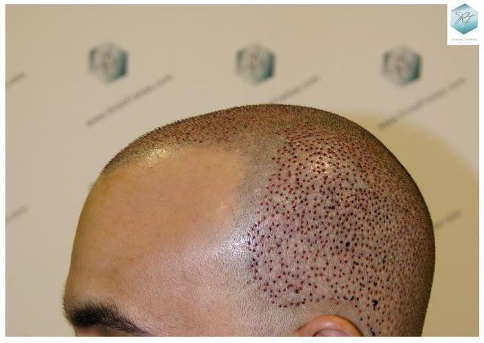 injerto pelo en españa