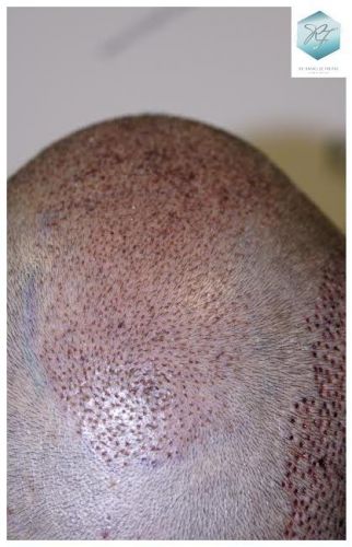 injerto pelo en españa