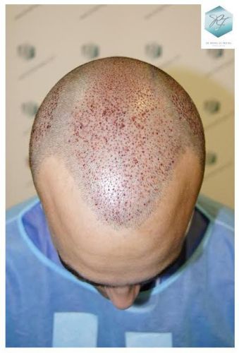 injerto pelo en españa