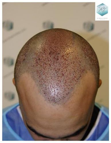injerto pelo en españa