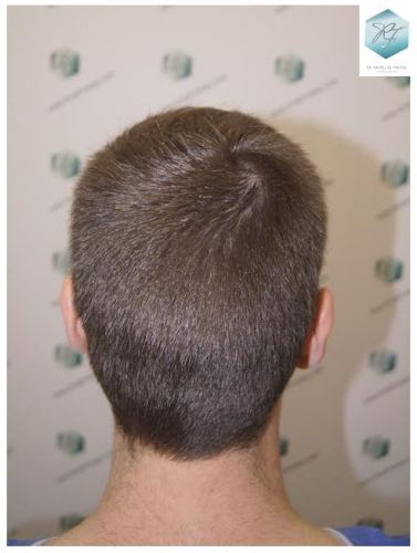 Injerto Capilar Técnica FUE 3124 Grafts (8727 Pelos) 36 injerto pelo en españa