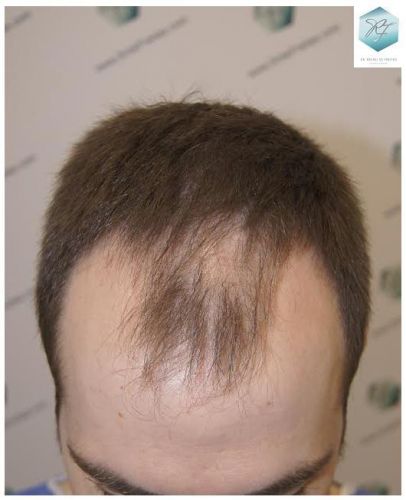 Injerto Capilar Técnica FUE 3124 Grafts (8727 Pelos) 1 injerto pelo en españa