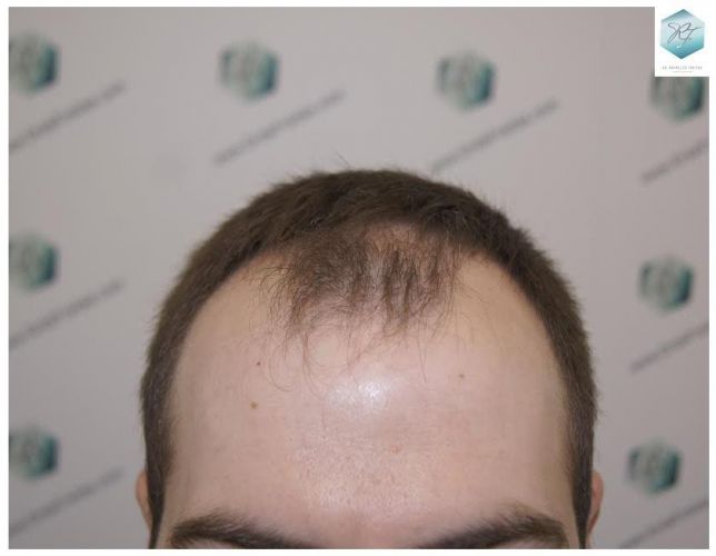 ANTES DEL TRASPLANTE CAPILAR injerto pelo en españa