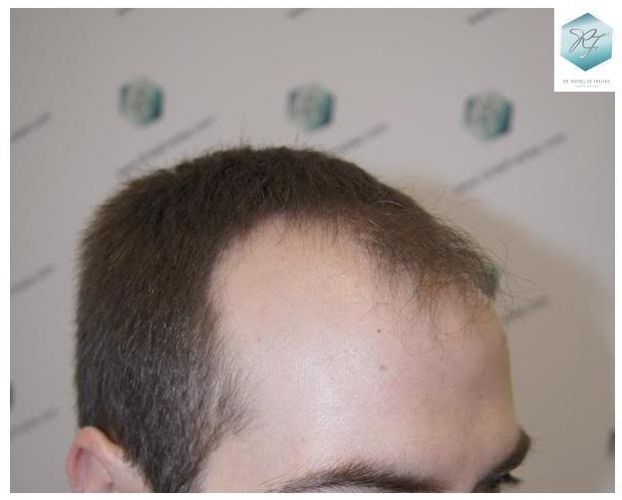 Injerto Capilar Técnica FUE 3124 Grafts (8727 Pelos) 3 injerto pelo en españa