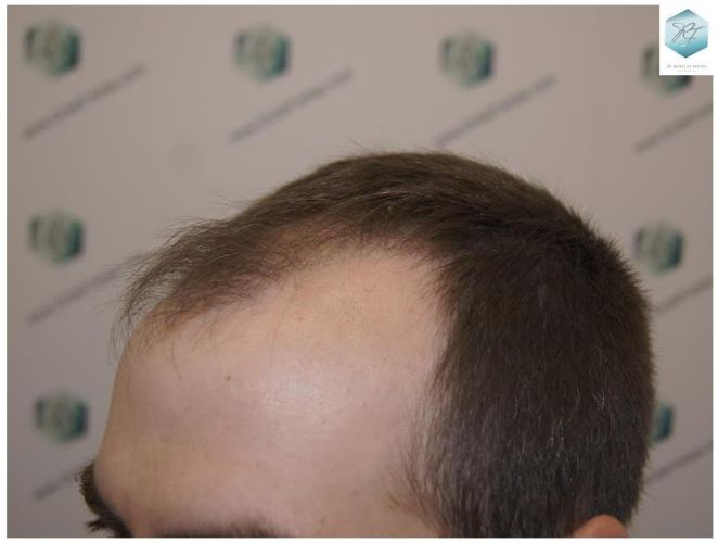 Injerto Capilar Técnica FUE 3124 Grafts (8727 Pelos) 5 injerto pelo en españa