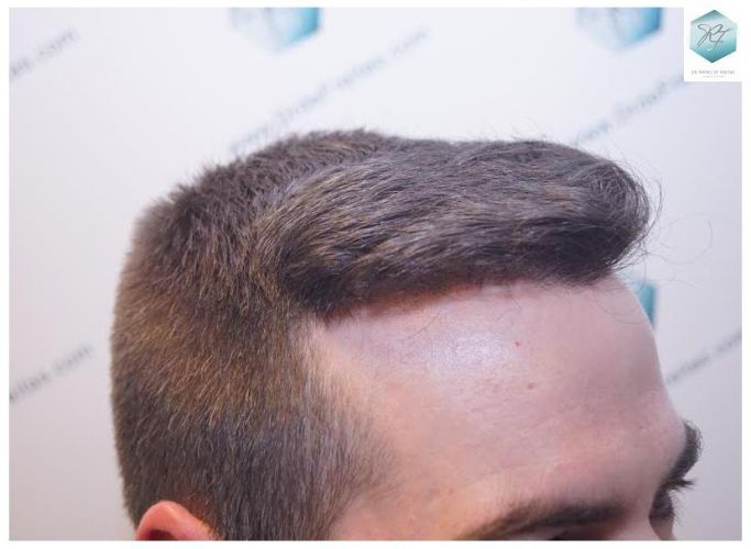 Injerto Capilar Técnica FUE 3124 Grafts (8727 Pelos) 23 injerto pelo en españa