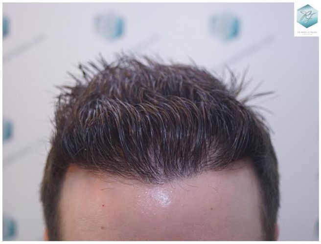 Injerto Capilar Técnica FUE 3124 Grafts (8727 Pelos) 29 injerto pelo en españa