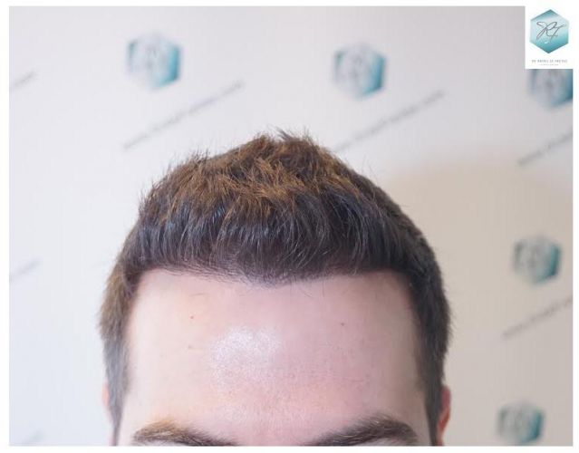 Injerto Capilar Técnica FUE 3124 Grafts (8727 Pelos) 21 injerto pelo en españa