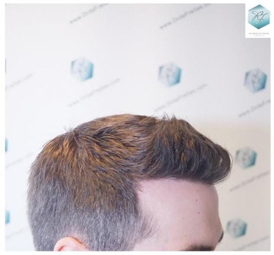 Injerto Capilar Técnica FUE 3124 Grafts (8727 Pelos) 25 injerto pelo en españa