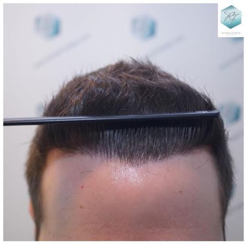 Injerto Capilar Técnica FUE 3124 Grafts (8727 Pelos) 30 injerto pelo en españa