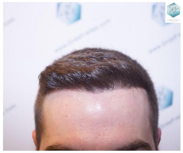 RESULTADOS A LOS 12 MESES injerto pelo en españa