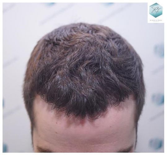 Injerto Capilar Técnica FUE 3124 Grafts (8727 Pelos) 22 injerto pelo en españa