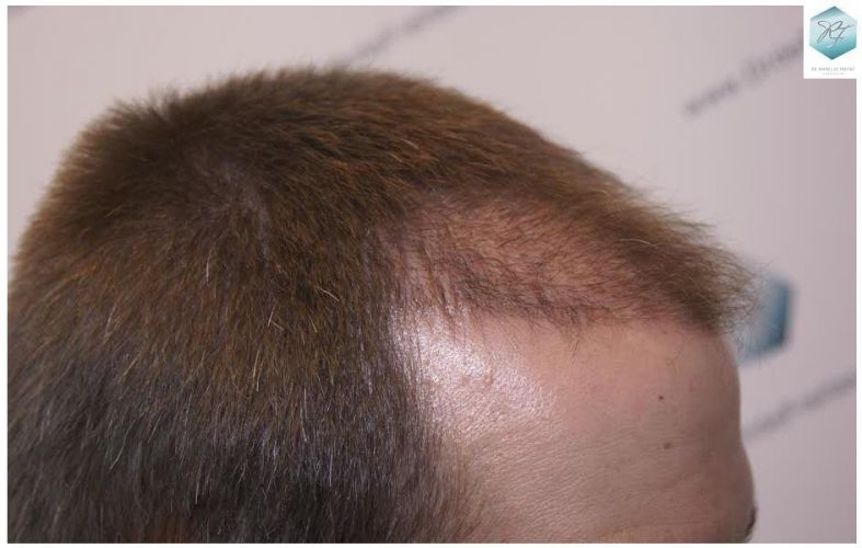 Injerto Capilar Técnica FUE 3124 Grafts (8727 Pelos) 16 injerto pelo en españa