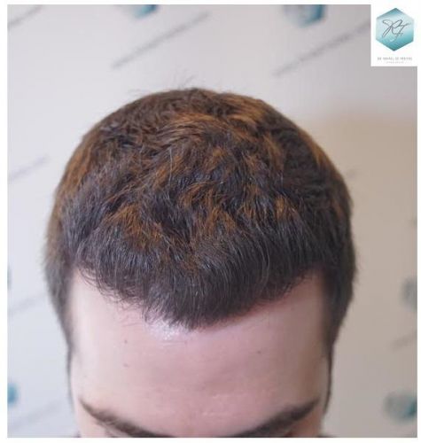 Injerto Capilar Técnica FUE 3124 Grafts (8727 Pelos) 20 injerto pelo en españa