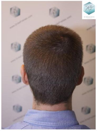 Injerto Capilar Técnica FUE 3124 Grafts (8727 Pelos) 19 injerto pelo en españa