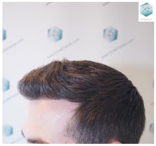 Injerto Capilar Técnica FUE 3124 Grafts (8727 Pelos) 26 injerto pelo en españa