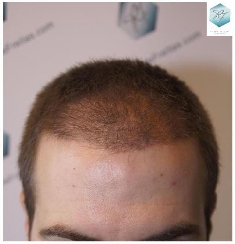 RESULTADOS A LOS 3 MESES injerto pelo en españa