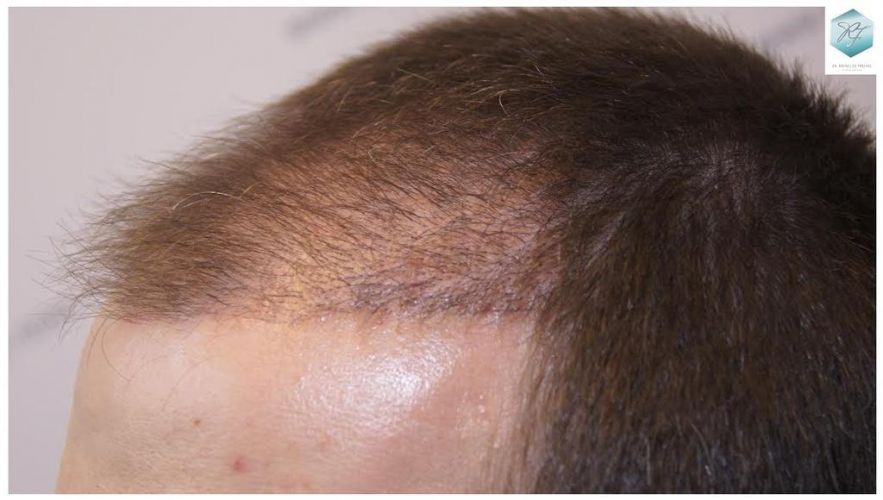 Injerto Capilar Técnica FUE 3124 Grafts (8727 Pelos) 17 injerto pelo en españa