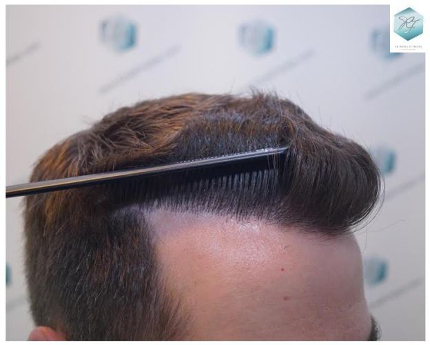 Injerto Capilar Técnica FUE 3124 Grafts (8727 Pelos) 24 injerto pelo en españa