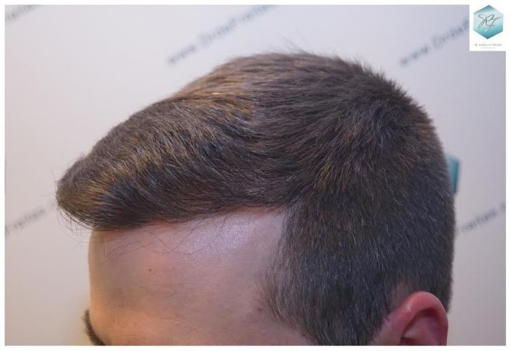 Injerto Capilar Técnica FUE 3124 Grafts (8727 Pelos) 27 injerto pelo en españa