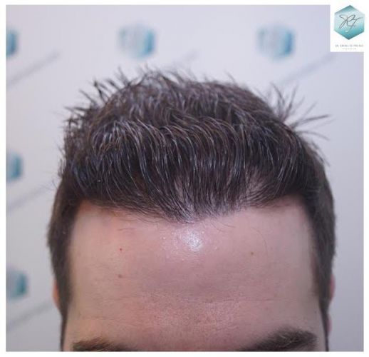 Injerto Capilar Técnica FUE 3124 Grafts (8727 Pelos) 28 injerto pelo en españa