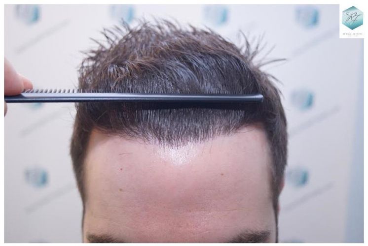 Injerto Capilar Técnica FUE 3124 Grafts (8727 Pelos) 33 injerto pelo en españa