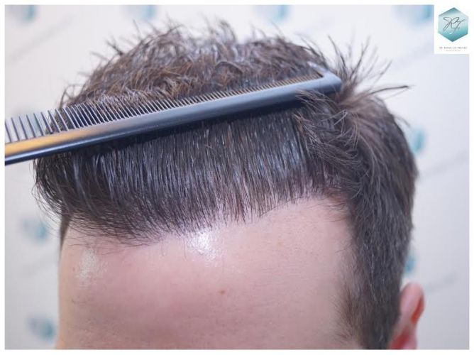 Injerto Capilar Técnica FUE 3124 Grafts (8727 Pelos) 34 injerto pelo en españa