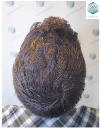 Injerto Capilar Técnica FUE 3124 Grafts (8727 Pelos) 32 injerto pelo en españa