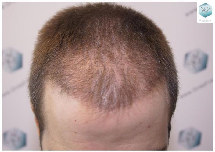 Injerto Capilar Técnica FUE 3124 Grafts (8727 Pelos) 15 injerto pelo en españa