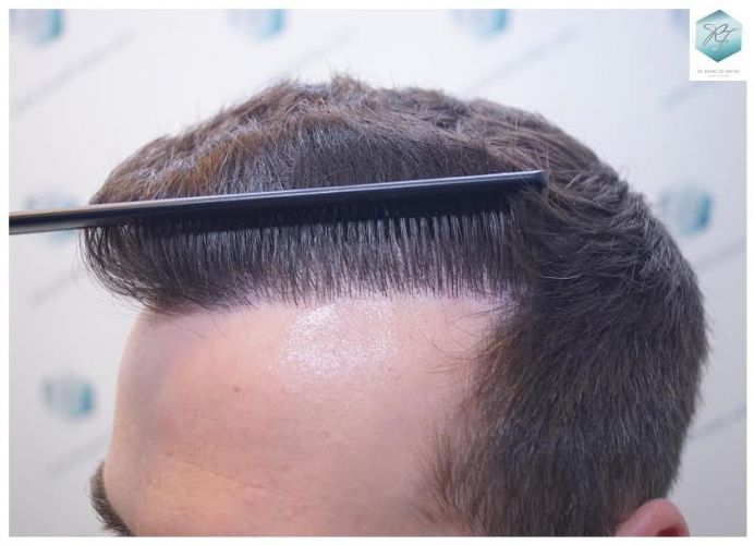Injerto Capilar Técnica FUE 3124 Grafts (8727 Pelos) 35 injerto pelo en españa