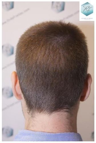 Injerto Capilar Técnica FUE 3124 Grafts (8727 Pelos) 18 injerto pelo en españa