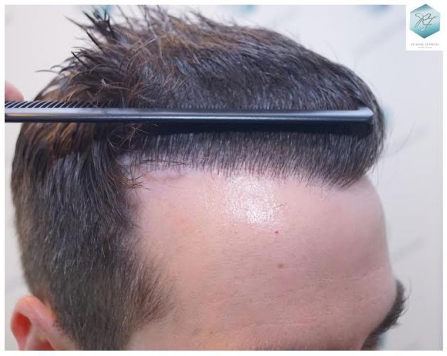 Injerto Capilar Técnica FUE 3124 Grafts (8727 Pelos) 31 injerto pelo en españa