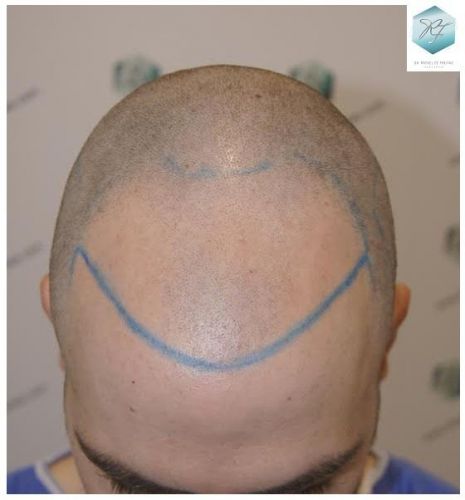 Injerto Capilar Técnica FUE 3124 Grafts (8727 Pelos) 9 injerto pelo en españa