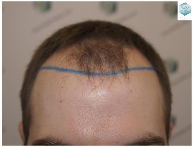 DISEÑO LINEA INJERTO CAPILAR injerto pelo en españa