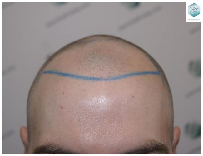 Injerto Capilar Técnica FUE 3124 Grafts (8727 Pelos) 7 injerto pelo en españa