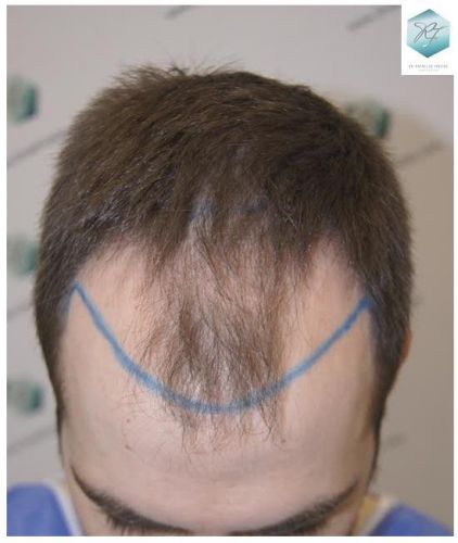 Injerto Capilar Técnica FUE 3124 Grafts (8727 Pelos) 6 injerto pelo en españa