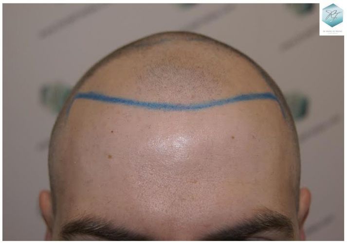 Injerto Capilar Técnica FUE 3124 Grafts (8727 Pelos) 8 injerto pelo en españa