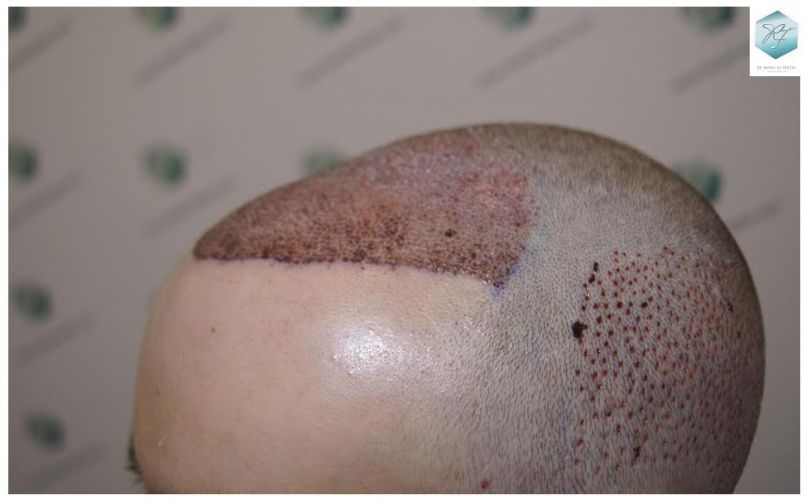 Injerto Capilar Técnica FUE 3124 Grafts (8727 Pelos) 13 injerto pelo en españa
