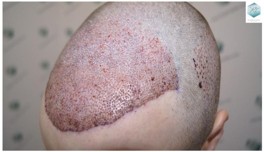 Injerto Capilar Técnica FUE 3124 Grafts (8727 Pelos) 12 injerto pelo en españa