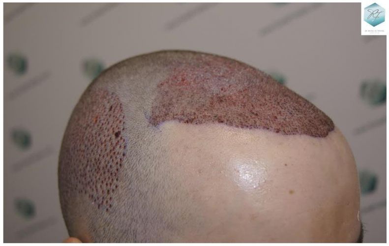 Injerto Capilar Técnica FUE 3124 Grafts (8727 Pelos) 10 injerto pelo en españa