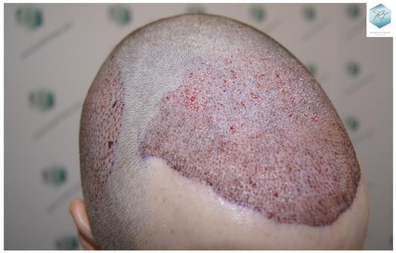 Injerto Capilar Técnica FUE 3124 Grafts (8727 Pelos) 11 injerto pelo en españa